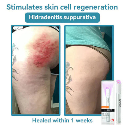 LUMIVO™ All-in-One CO₂ Laser Eraser Pen | Removes Moles, Warts, Skin Flaws & Pigmentation